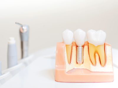 Prótesis Dentales en Clínica DentalCer