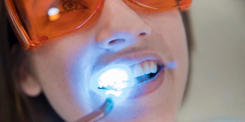 blanqueamiento por fotoactivación